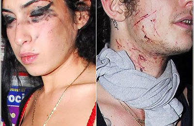 Amy Winehouse In Bloody Brawl With Husband