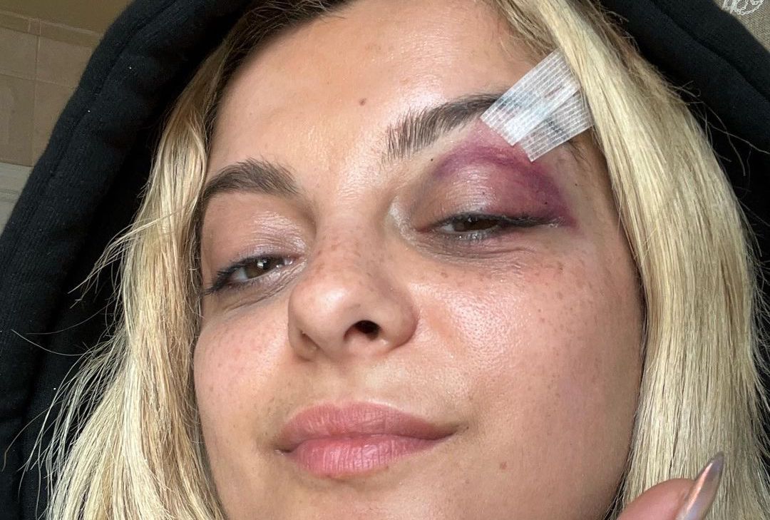 Bebe Rexha Shares SHOCKING Pictures of Bruises After Being Hit in the Face with a Phone